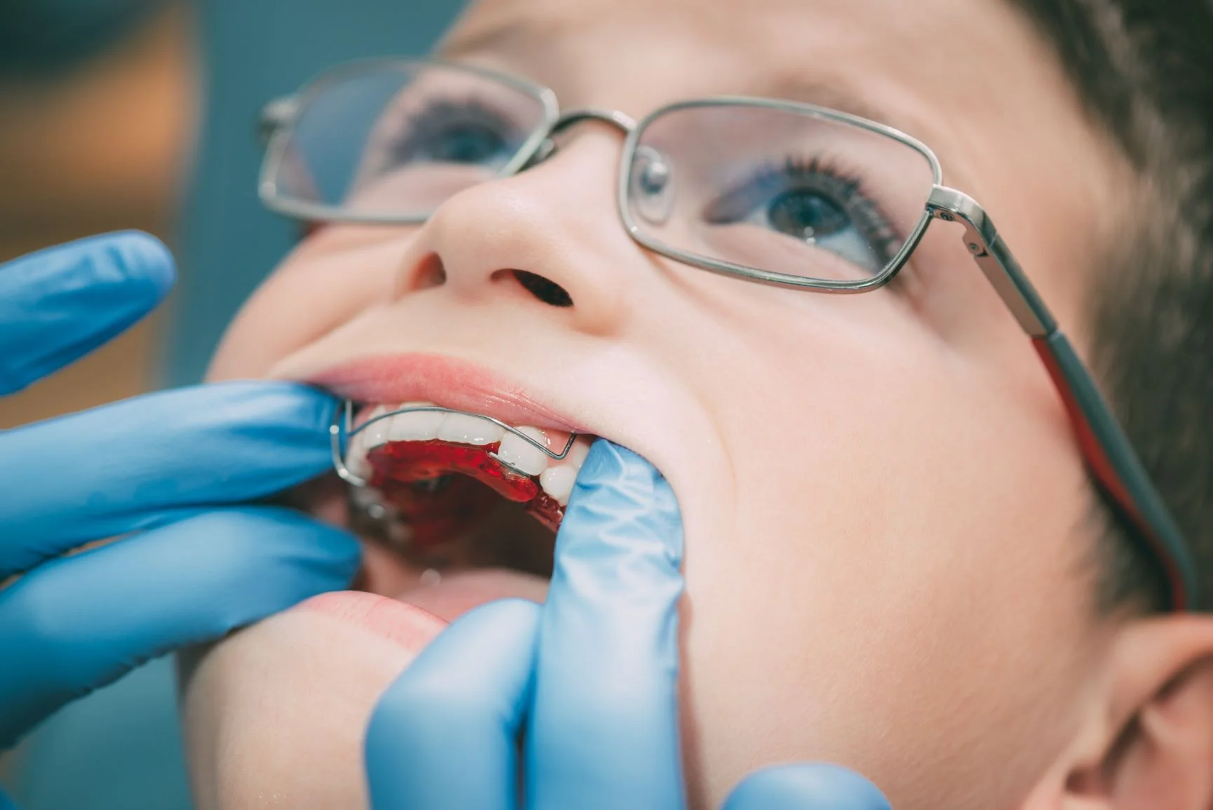 advancedortho2020.jpg A child with glasses has a retainer fitted by gloved hands, mouth open, at a dental appointment.