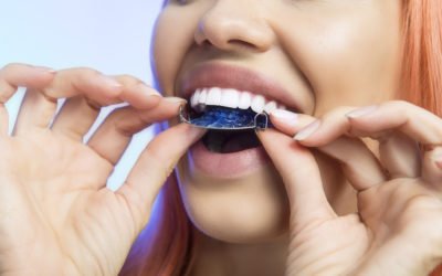 How Long Do I need A Retainer After Braces?