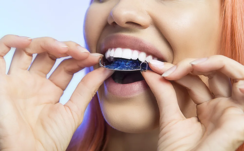 How Long Do I need A Retainer After Braces?