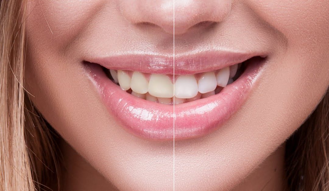 Things To Know When Whitening Your Teeth