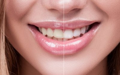 Things To Know When Whitening Your Teeth