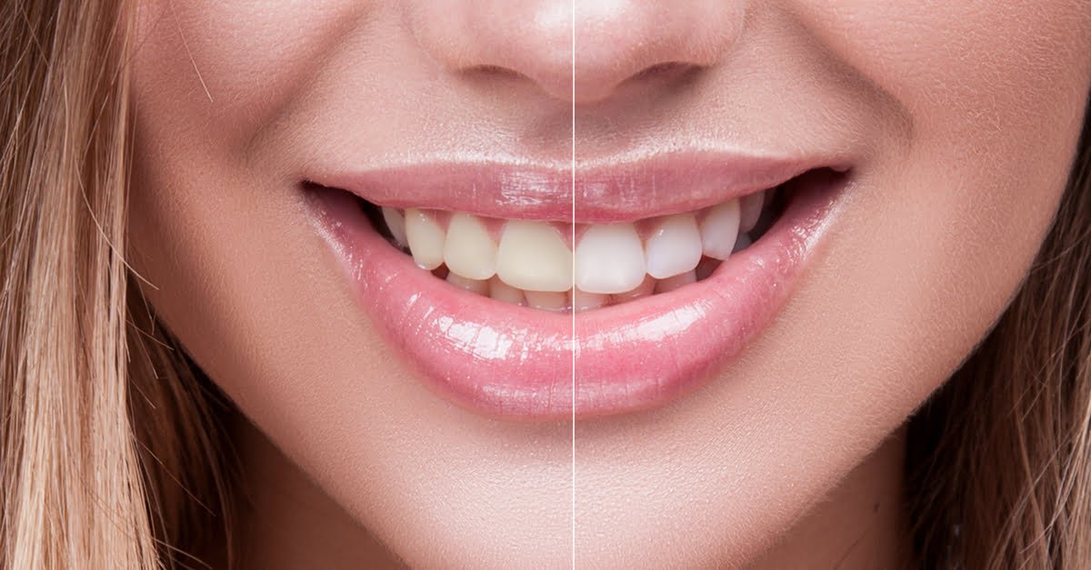 Things To Know When Whitening Your Teeth