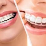 Split image of a person with metal braces on the left and clear aligners on the right, illustrating why teens often choose Invisalign for a more discreet option.
