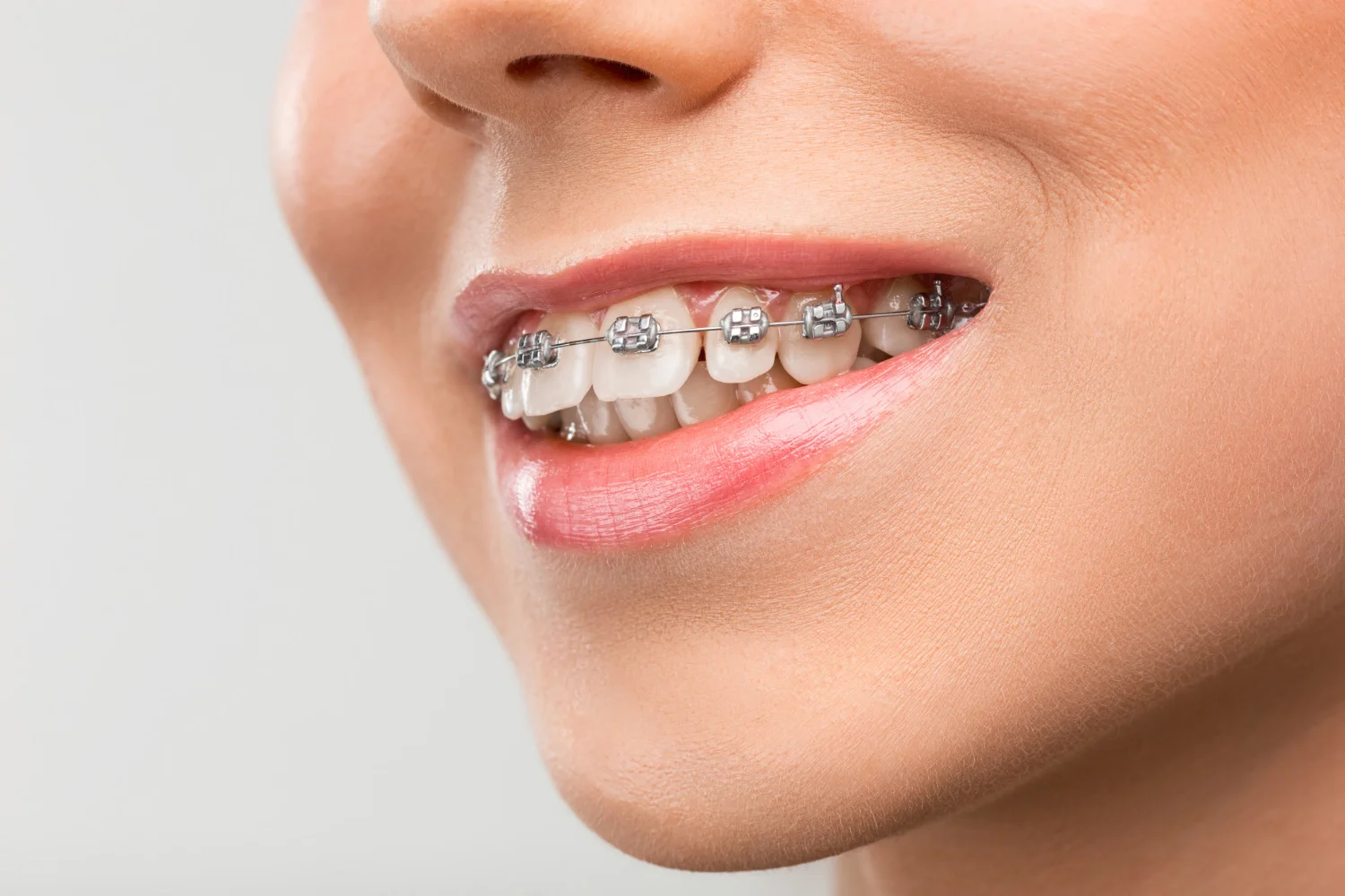 Close-up of a smiling person with metal braces on their teeth.
