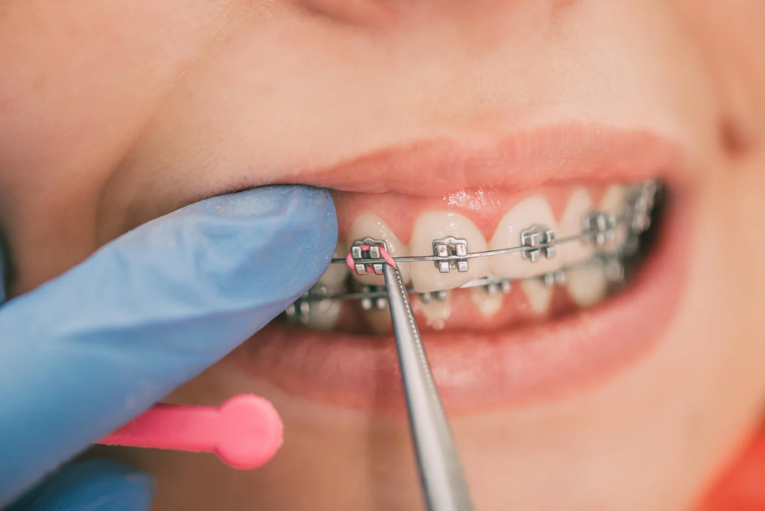 Close-up of a person’s mouth with braces being adjusted using dental tools.