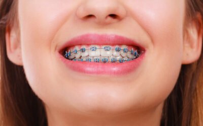 How Metal Braces Compare to Other Orthodontic Treatments