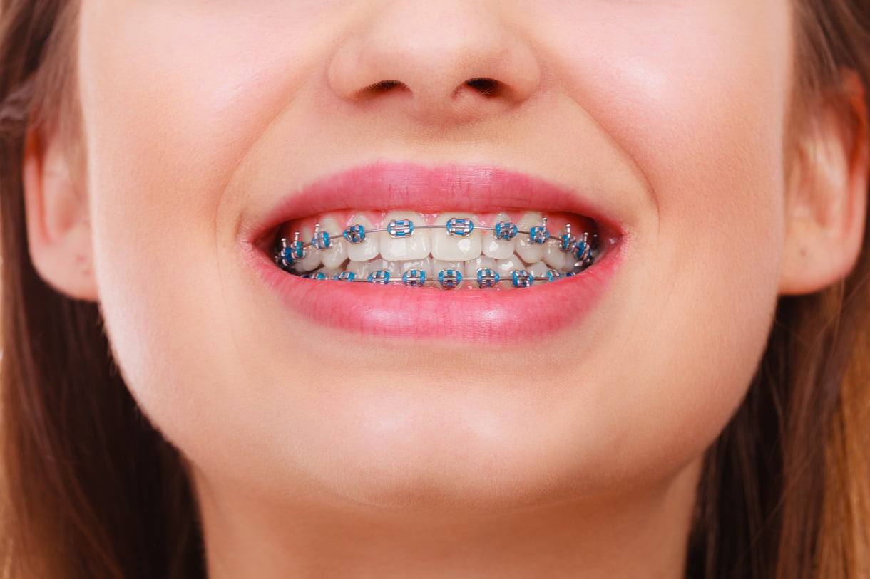 Metal Braces