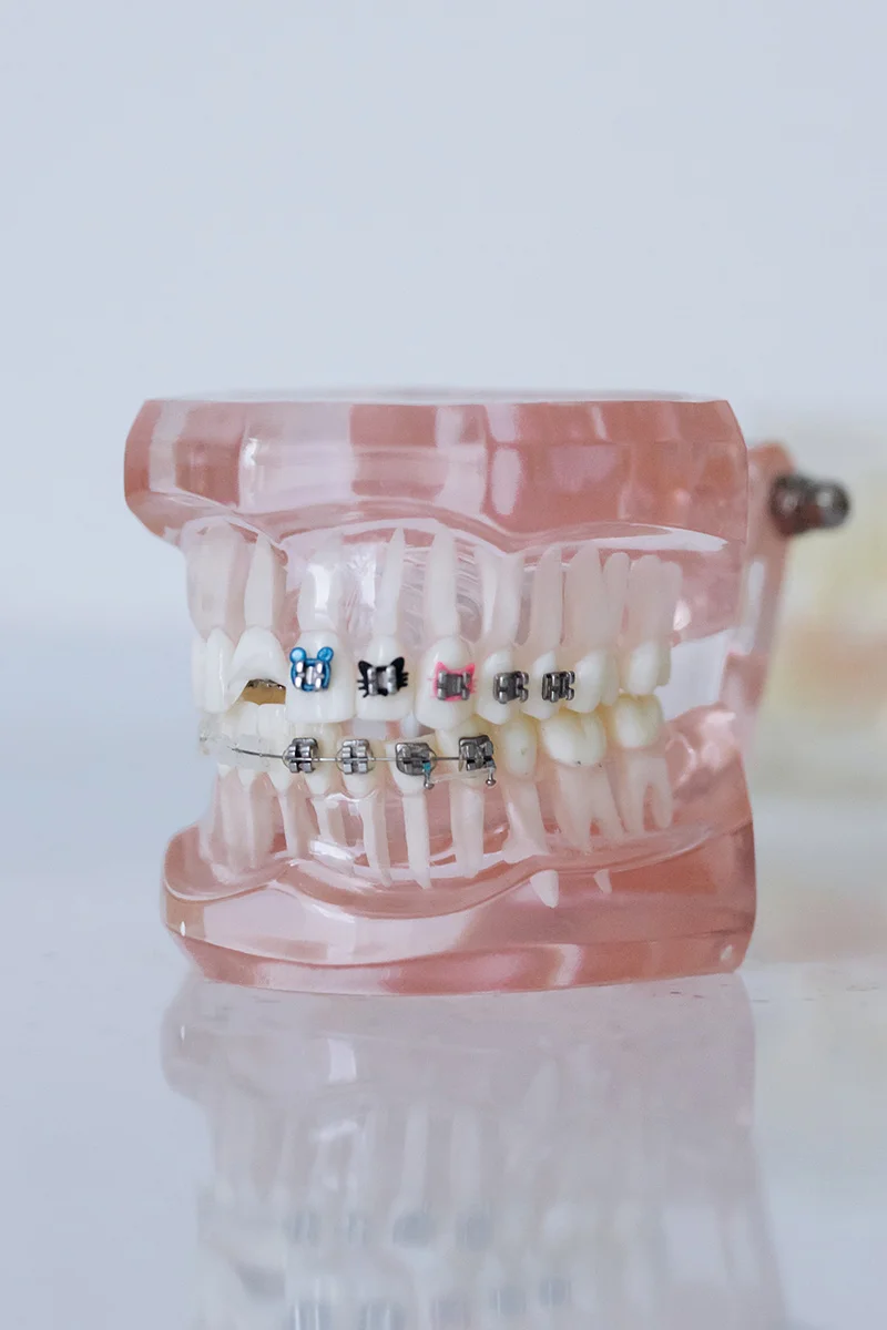 A dental model with braces on the teeth, showing orthodontic brackets and wires.
