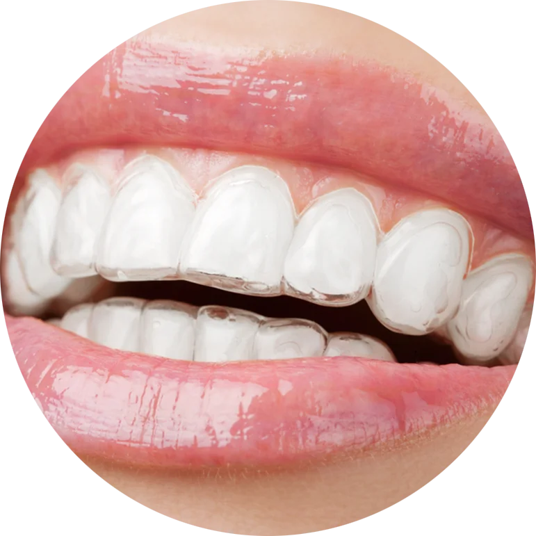 Close-up of a smiling mouth wearing clear dental aligners on upper and lower teeth.