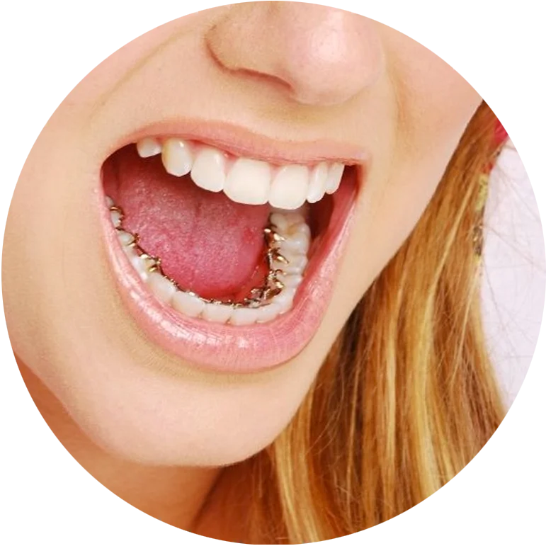 A woman smiling with her mouth open, showing lingual braces on her lower teeth.