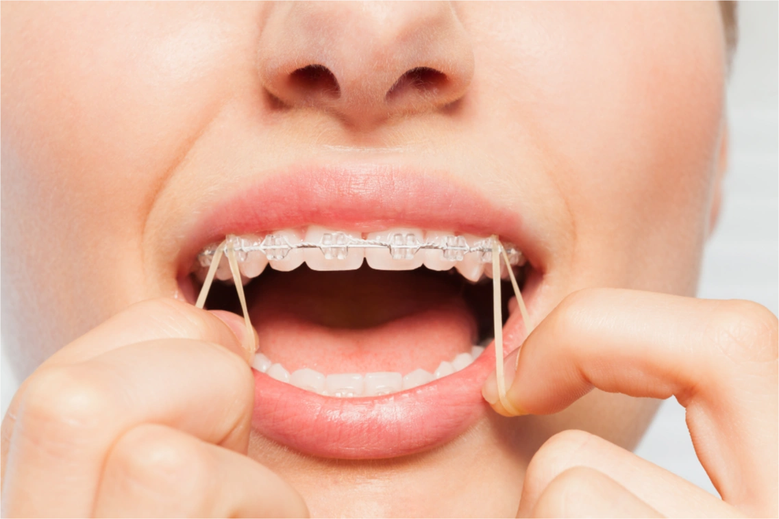 Close-up of a person attaching orthodontic elastic bands to clear braces on their teeth.