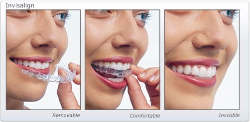invisalign1-1