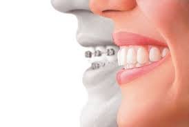 invisalign4