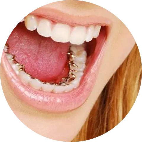 Open mouth showing lingual braces on lower teeth and white upper teeth, tongue partially out.