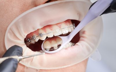 How Orthodontic Treatment Improves Oral Health Beyond Straight Teeth