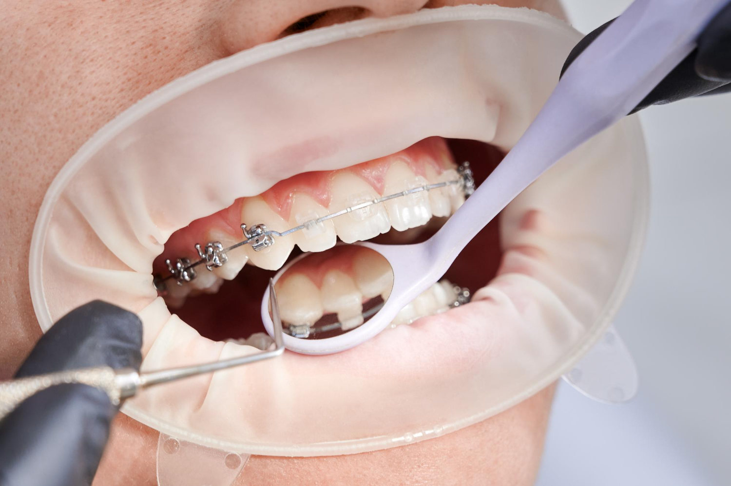 Close-up of a person's mouth with braces during a dental check-up, using a mirror and dental tool.