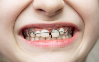 Do You Need a Retainer Forever? What Happens After Braces or Invisalign