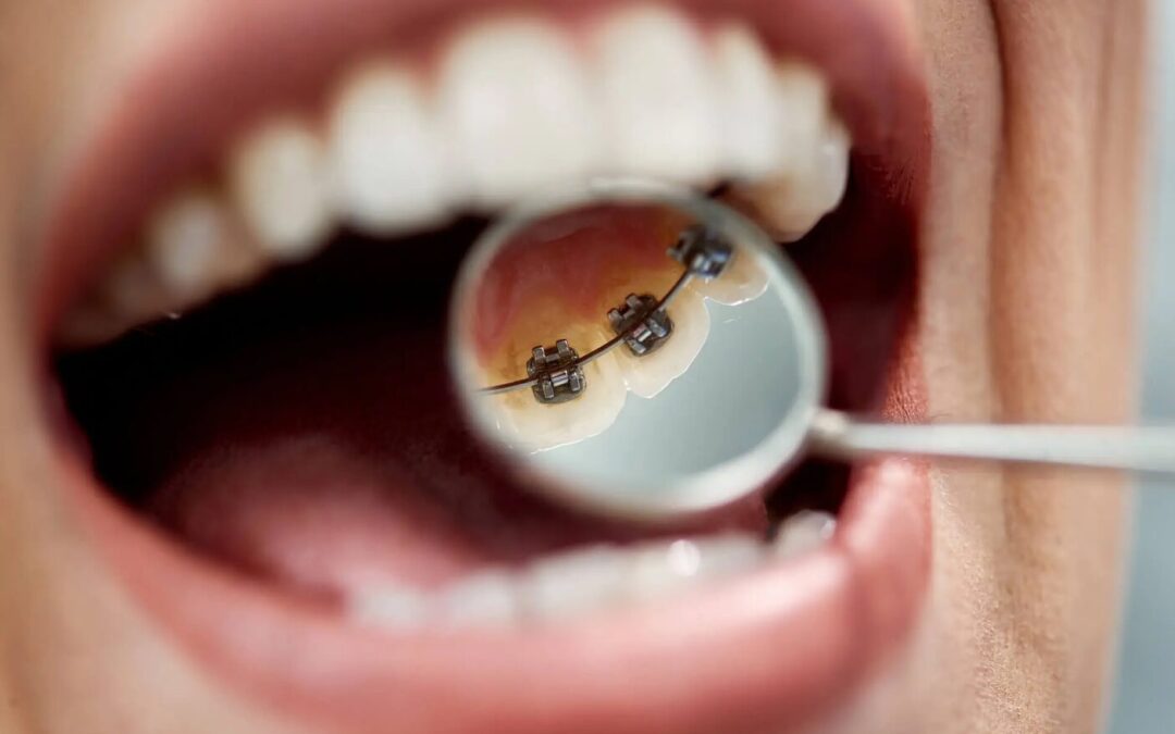 Lingual Braces: A More Discreet Way to Straighten Your Smile