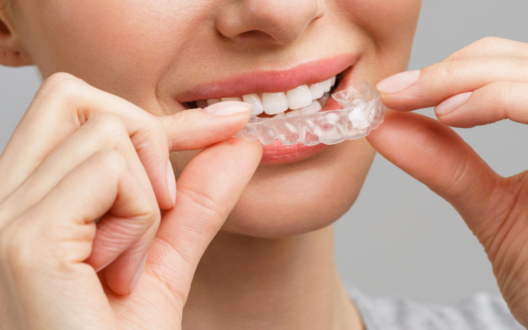 Can Invisalign Fix Bite Problems? Understanding More Than Just Crooked Teeth