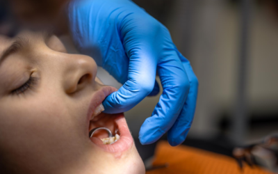 Orthodontic Emergencies: What to Do When a Bracket, Wire, or Appliance Breaks